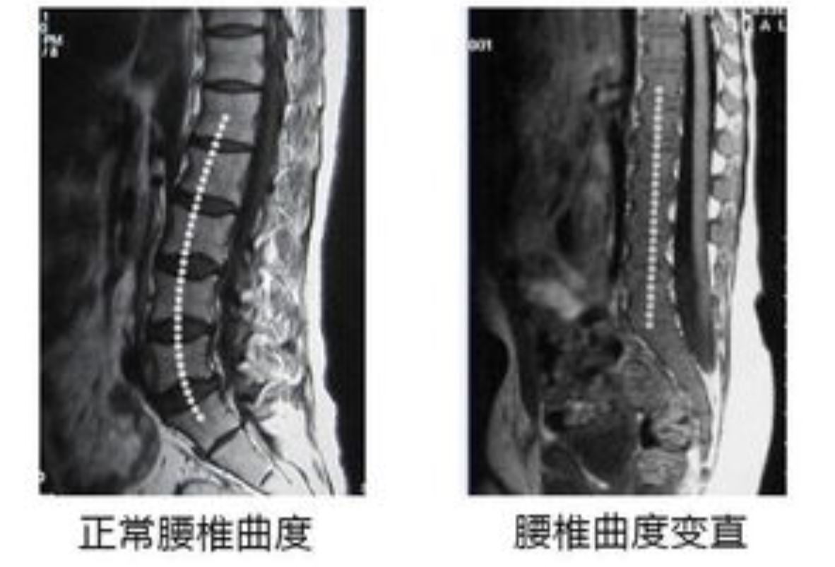 醫生報告單說我腰椎曲度變直了該怎麼辦