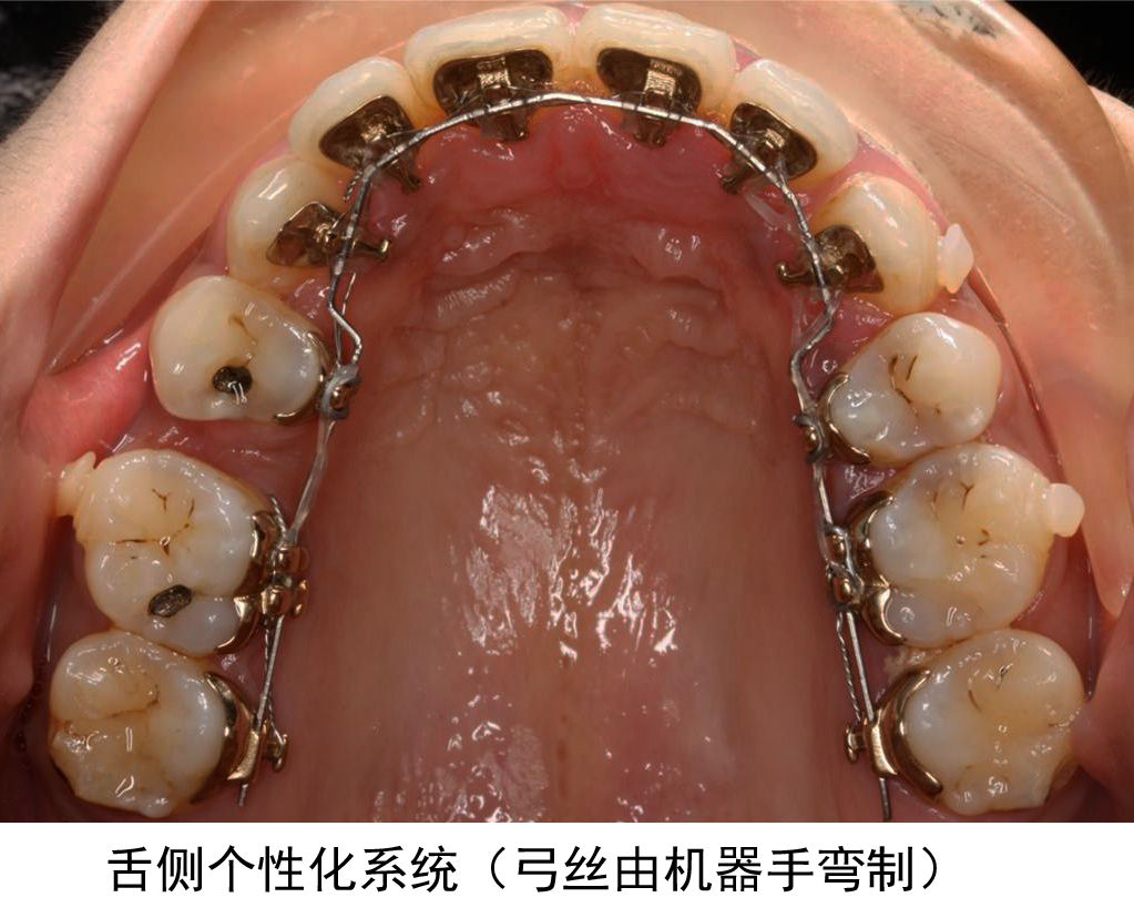 舌侧直丝弓矫正技术