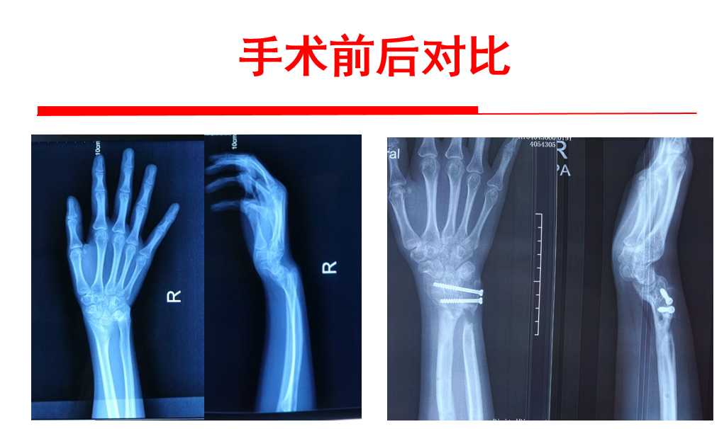 腕骨呈v形,下尺桡脱位,右侧为矫正后最终的x片图3 从左至右依次为