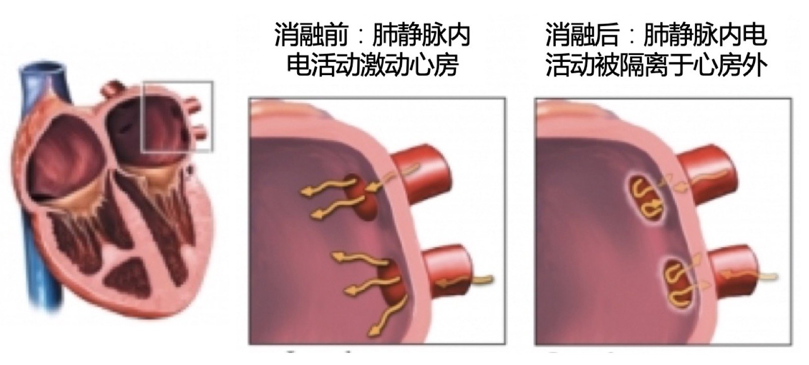 手術的過程:房顫射頻消融術為介入微創手術,手術創傷很小,僅在左右股