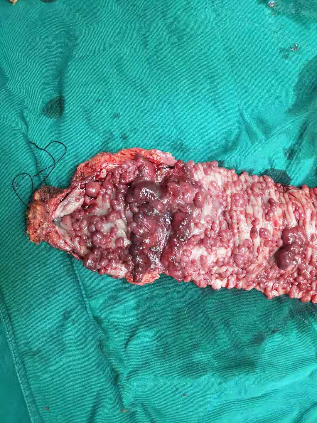 家族性腺瘤性息肉病